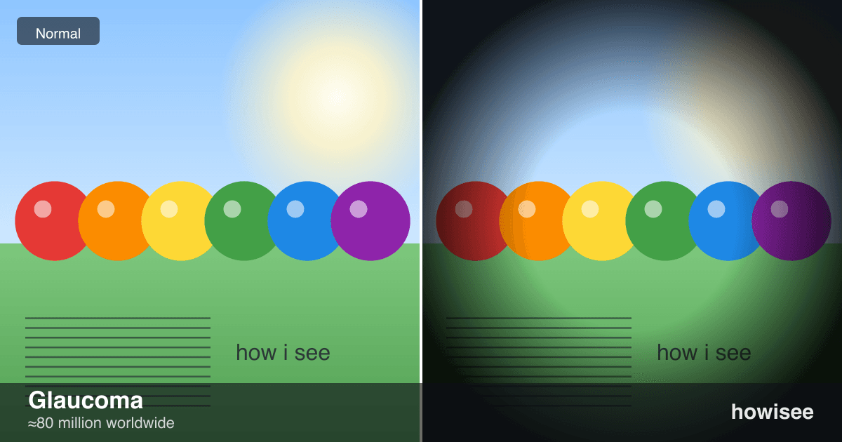 A before/after showing Glaucoma: a normal scene on the left, the same scene as seen with Glaucoma on the right