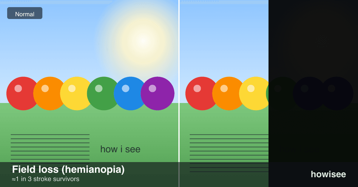 A before/after showing Field loss (hemianopia): a normal scene on the left, the same scene as seen with Field loss (hemianopia) on the right