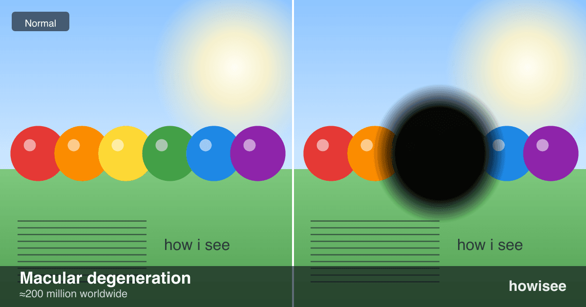 A before/after showing Macular degeneration: a normal scene on the left, the same scene as seen with Macular degeneration on the right