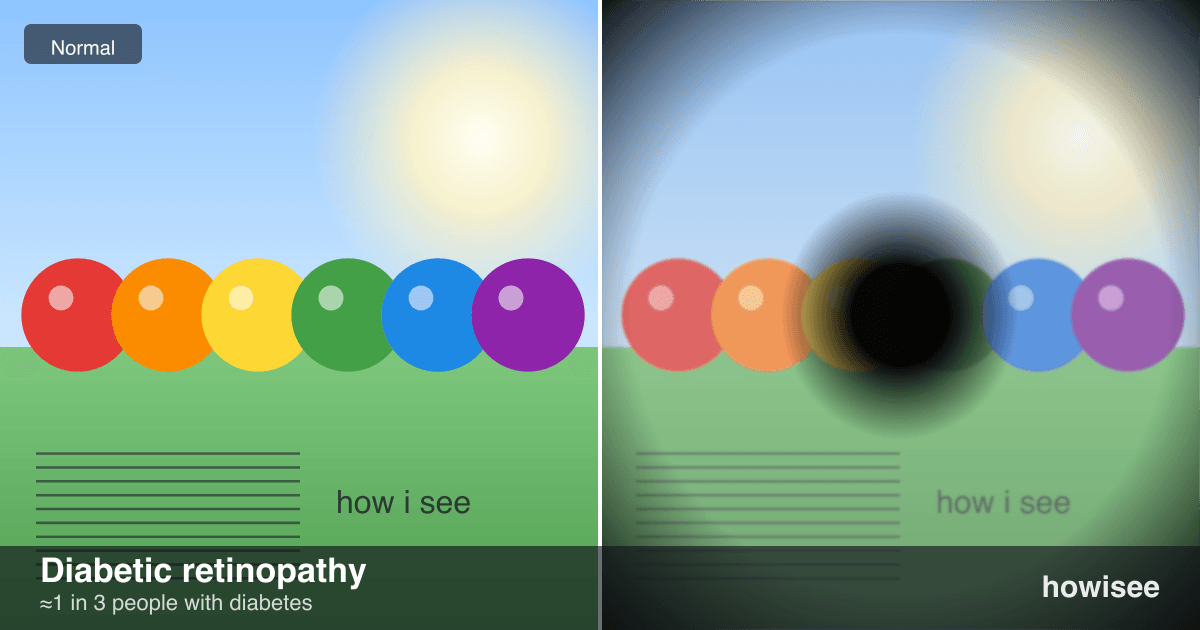A before/after showing Diabetic retinopathy: a normal scene on the left, the same scene as seen with Diabetic retinopathy on the right
