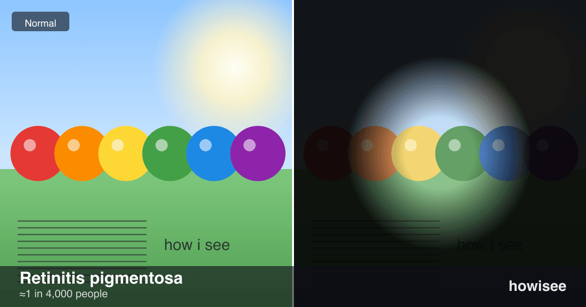 A before/after showing Retinitis pigmentosa: a normal scene on the left, the same scene as seen with Retinitis pigmentosa on the right